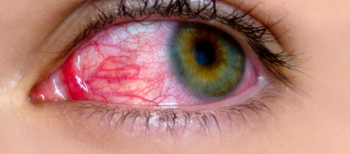 Οι αιτίες και τα συμπτώματα της επιπεφυκίτιδας